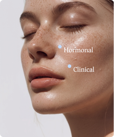 Close-up of a woman’s skin with hormonal and clinical acne markers from the telehealth platform design